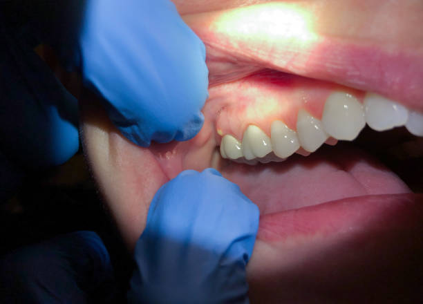 Best Emergency Dentist for Lost Fillings or Crowns in Sound Beach, NY